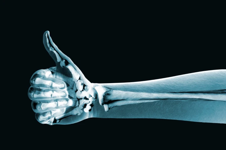A new injectable drug is claimed to significantly speed up the healing of fractured bones