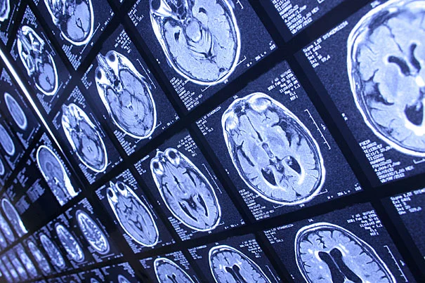 MRI is used to measure deviations in brain circuitry to detect Autism in under 10 minutes with 94 percent success rate