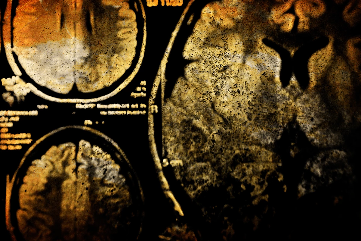 A new study has uncovered how brain injury can be worsened by bacteria in the gut