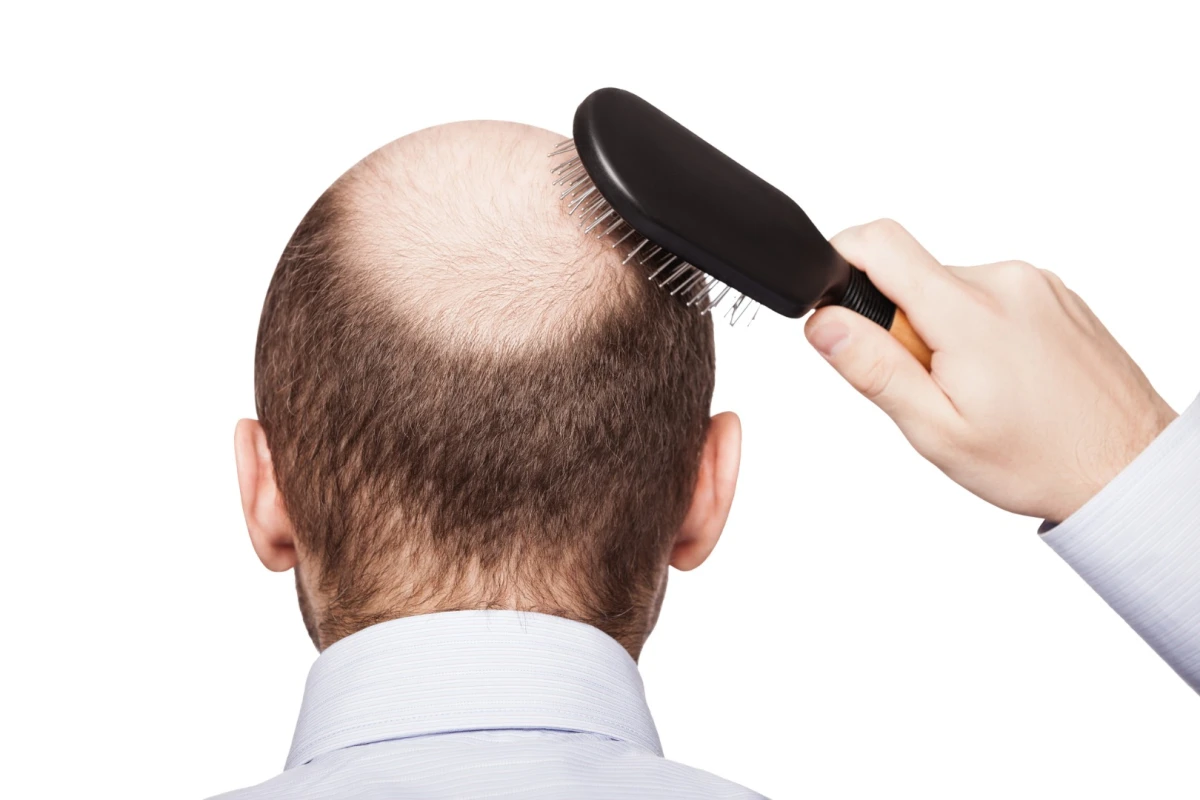A 50-year-old drug has opened up a new avenue in the quest for a baldness cure
