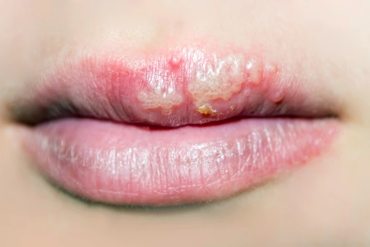 Another study has linked the common herpes virus with Alzheimer's disease