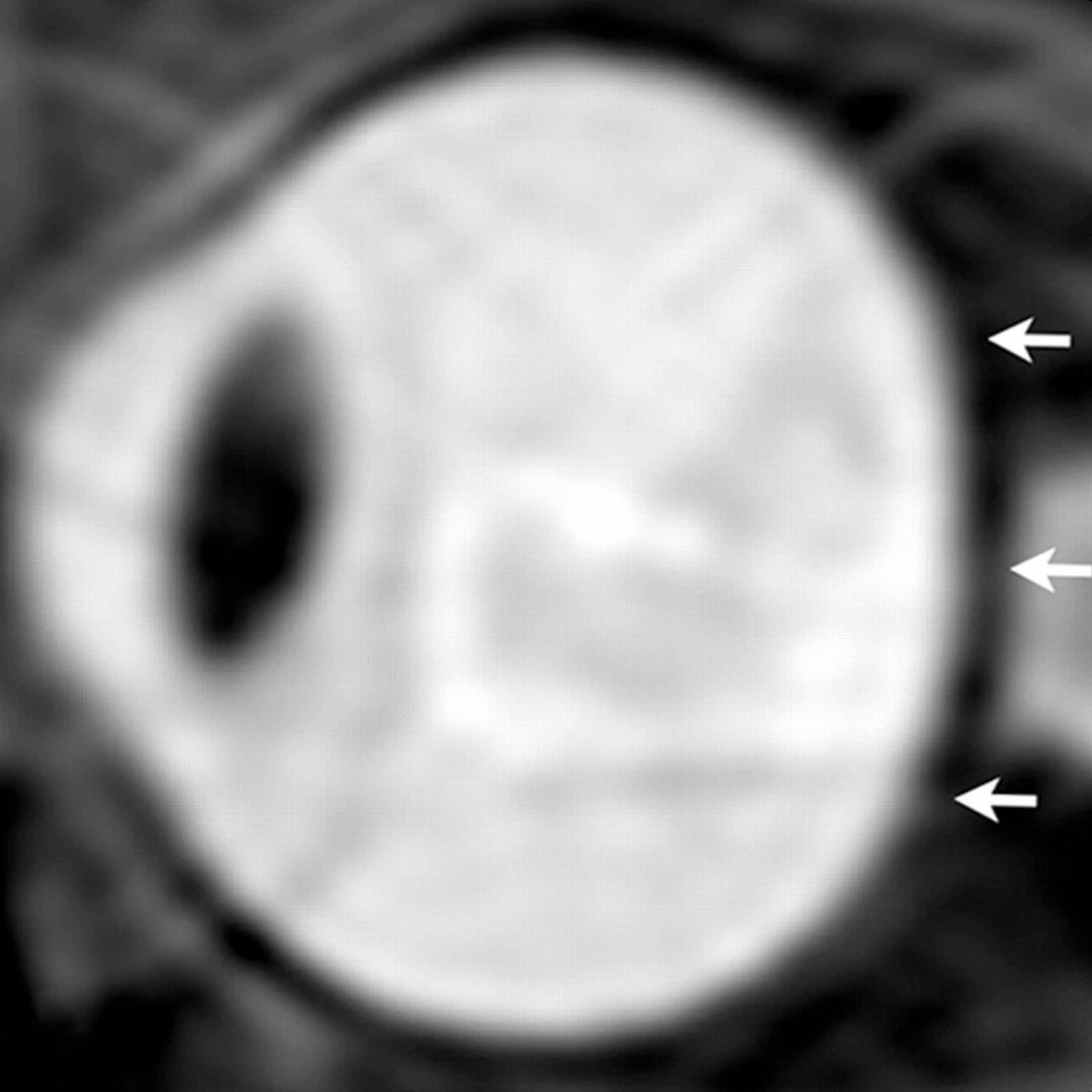 From a study of astronauts in 2012, sagittal oblique T2-weighted MR image of left eye before long-term flight.