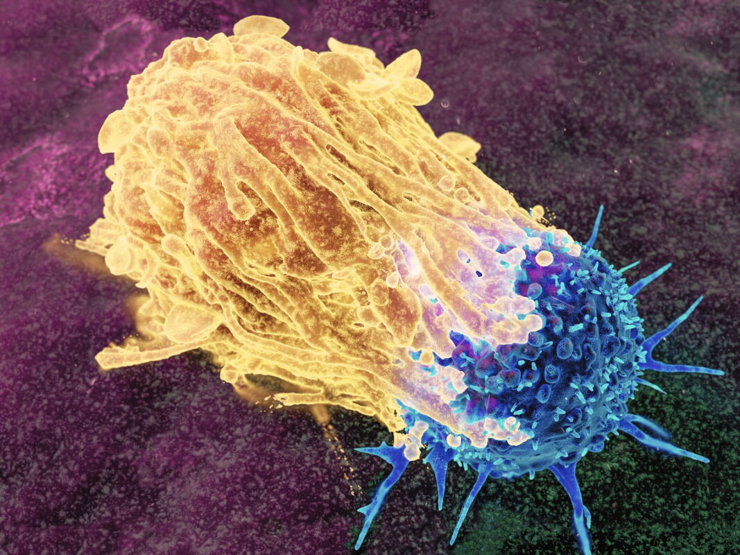 An overlooked immune cell offers a way to treat deadliest lung cancers