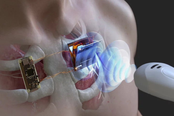 An illustration depicting how the device could periodically receive ultrasound from an external transducer