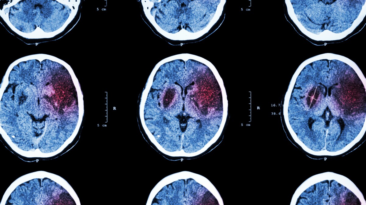 Machine learning model accurately predicts stroke using existing data