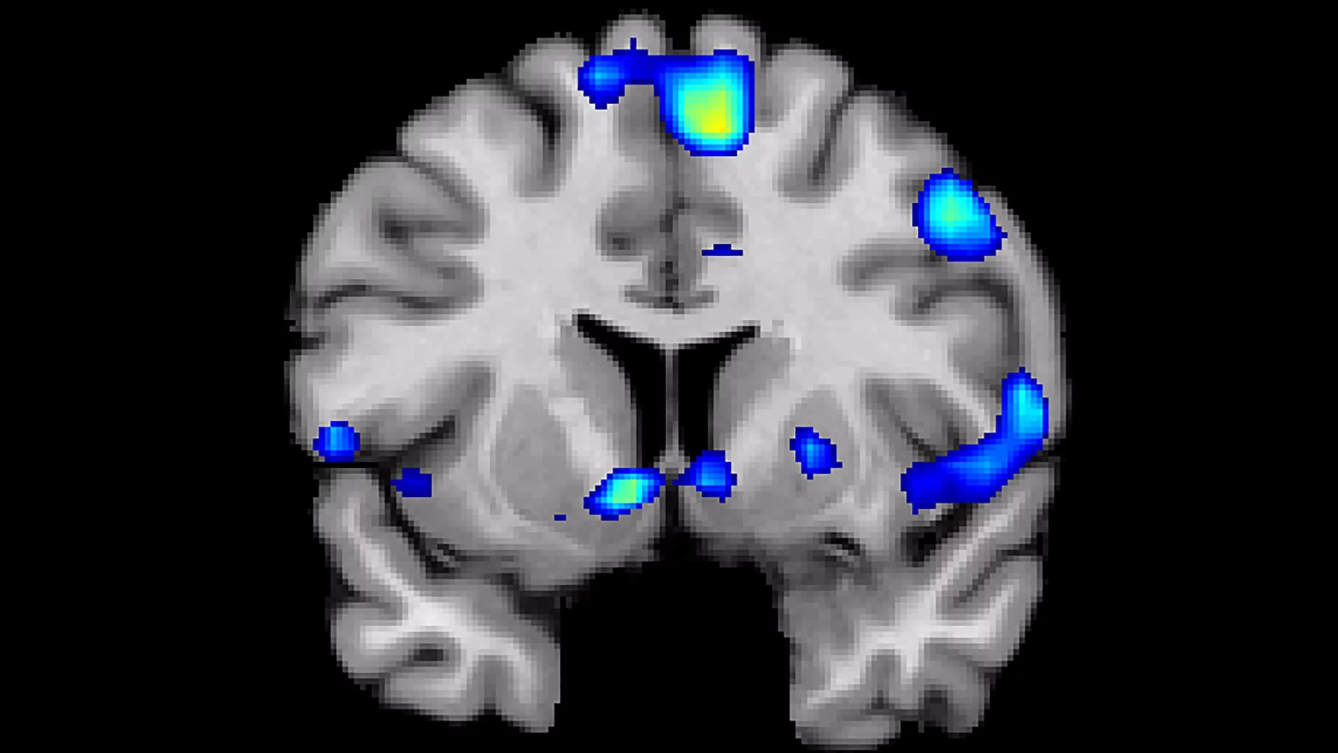 A scan shows regions of the brain that become active when devoutly religious study participants have a spiritual experience