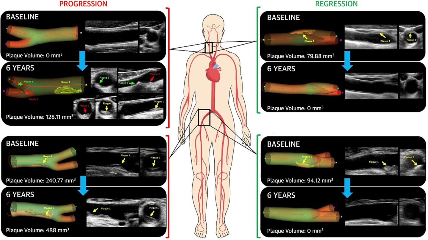 Participant examples of six-year subclinical atherosclerosis progression and regression