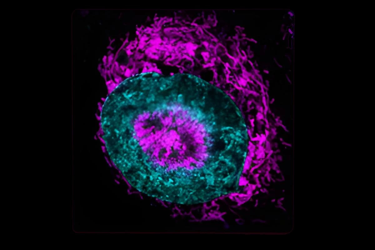 This cancer cell under pressure shows the mitochondria in magenta accumulating around the nucleus, shown in blue. It also shows a build-up in the dimple formed at the center of the nucleus