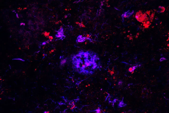 Antibodies (red) bind to the amyloid plaques (blue) in brain tissue