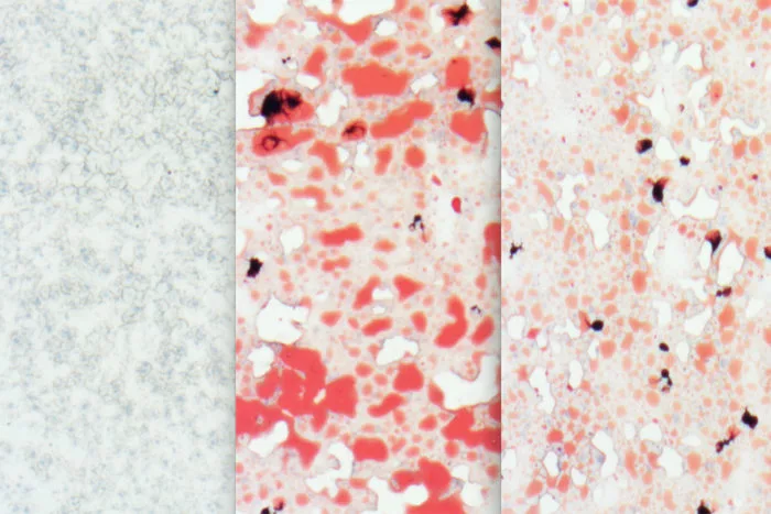 A comparison of the livers of different groups of mice – left is a healthy mouse liver, middle shows the fatty deposits (red) left by a high-fat/cholesterol diet over 12 weeks, and the right image shows that same high-fat diet in mice with high levels of Aloxe3 expression