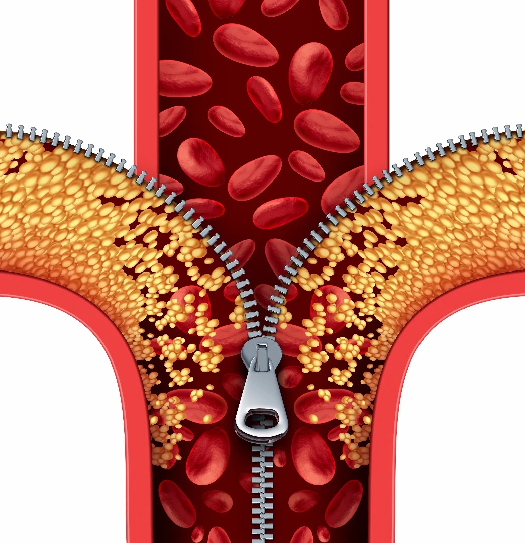 Scientists have discovered that a cancer drug can also combat fatty arteries by reducing inflammation and mimicking exercise
