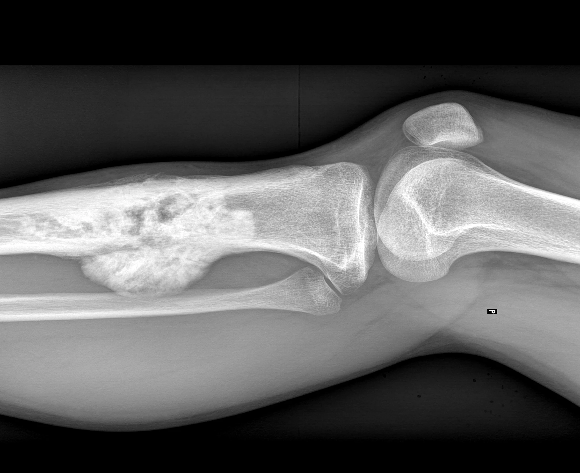 Osteosarcoma of a human tibia (shin bone)