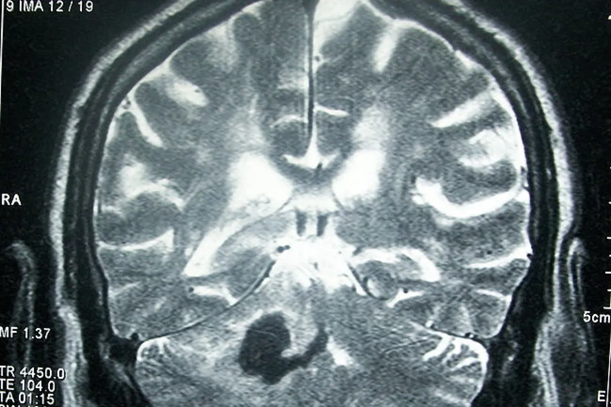 An experimental new stroke treatment replicates and enhances the brain's natural reaction to being in an enriched, stimulating environment (Image: Bobjgalindo)