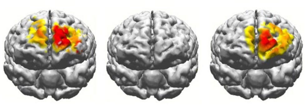 During memory tasks, brain activity associated with working memory lights up in the brain of a 20-year-old as seen on the left, but remains inactive in the brain of a 70-year-old as seen in the middle. But he 70-year-old’s brain activity mimics the 20-year-old’s following the stimulation, as seen on the right