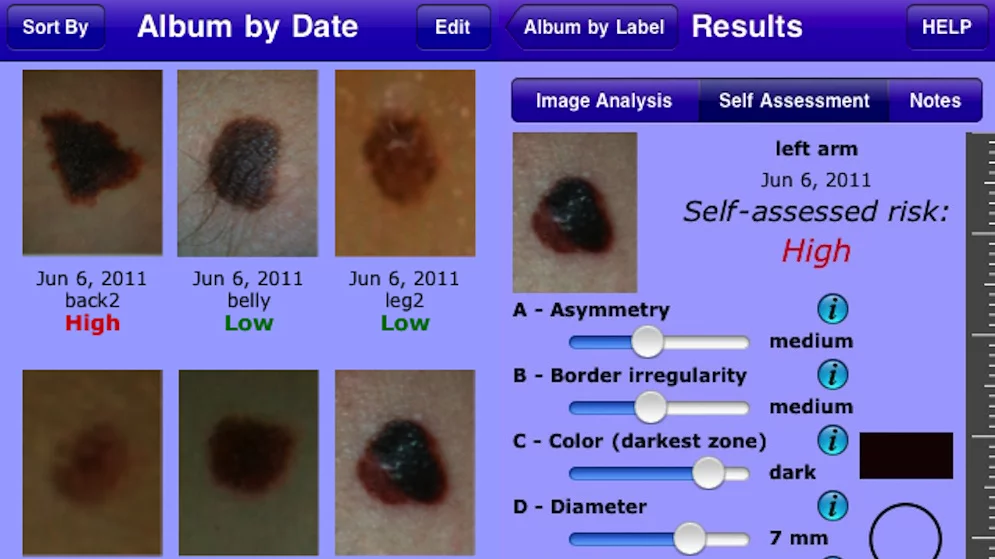 MelApp is an image-based risk assessment mobile app that assists in the early detection of melanoma