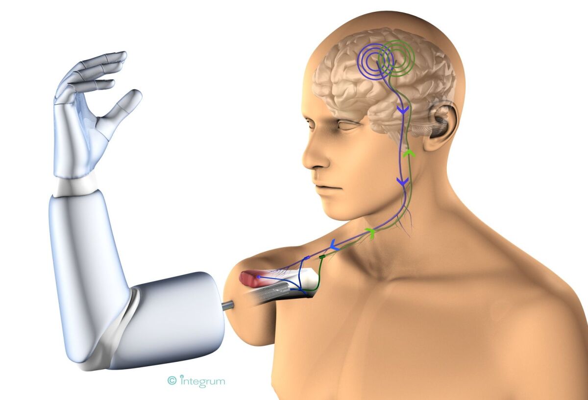 A diagram of Chalmers' implanted prosthetics system