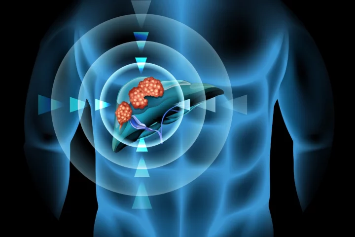 Heat-sensitive capsules were warmed up using ultrasound to release their chemotherapy drug payload in the liver