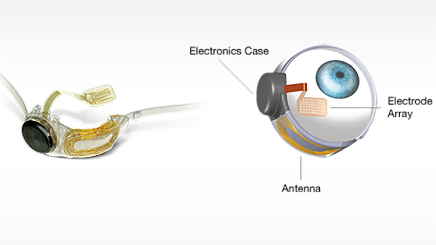 The Argus II System is designed to stimulate a patient's remaining retinal cells, allowing them to obtain useful visual information