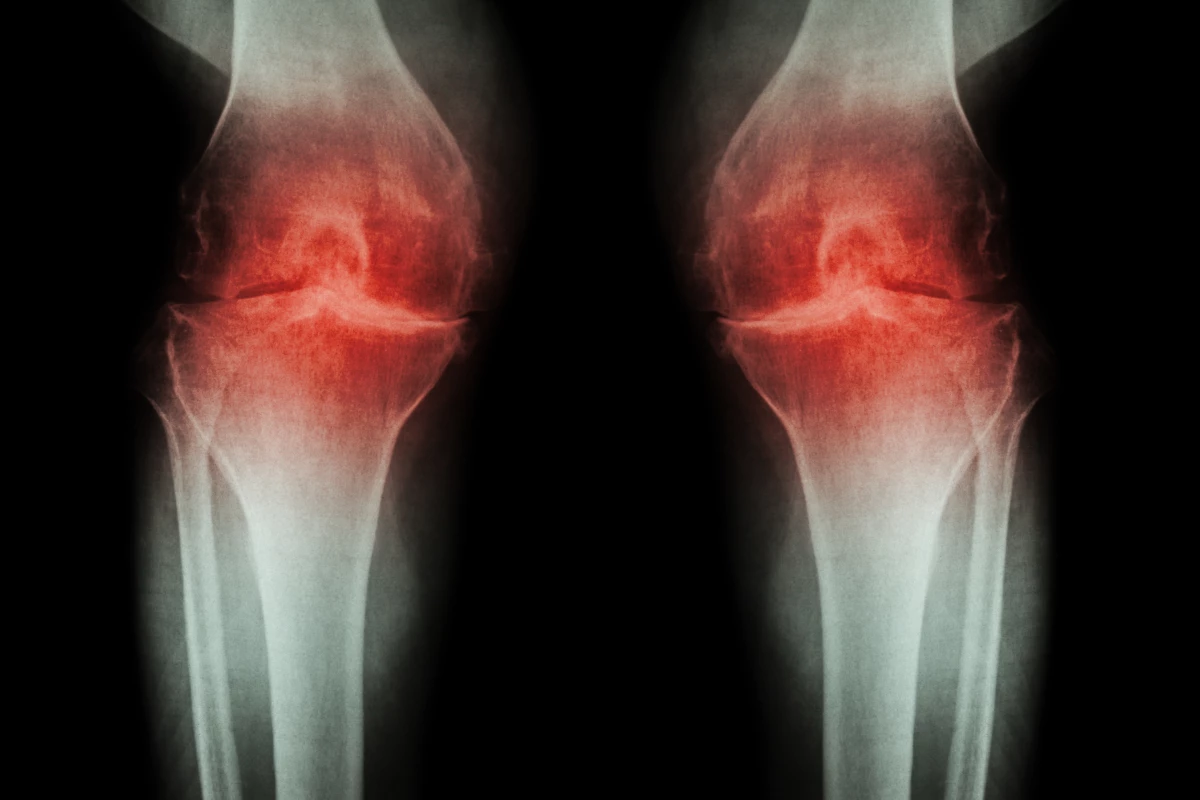 New research has found long-term use of common anti-inflammatory pain relievers did not lead to improvements in inflammatory signs of osteoarthritis