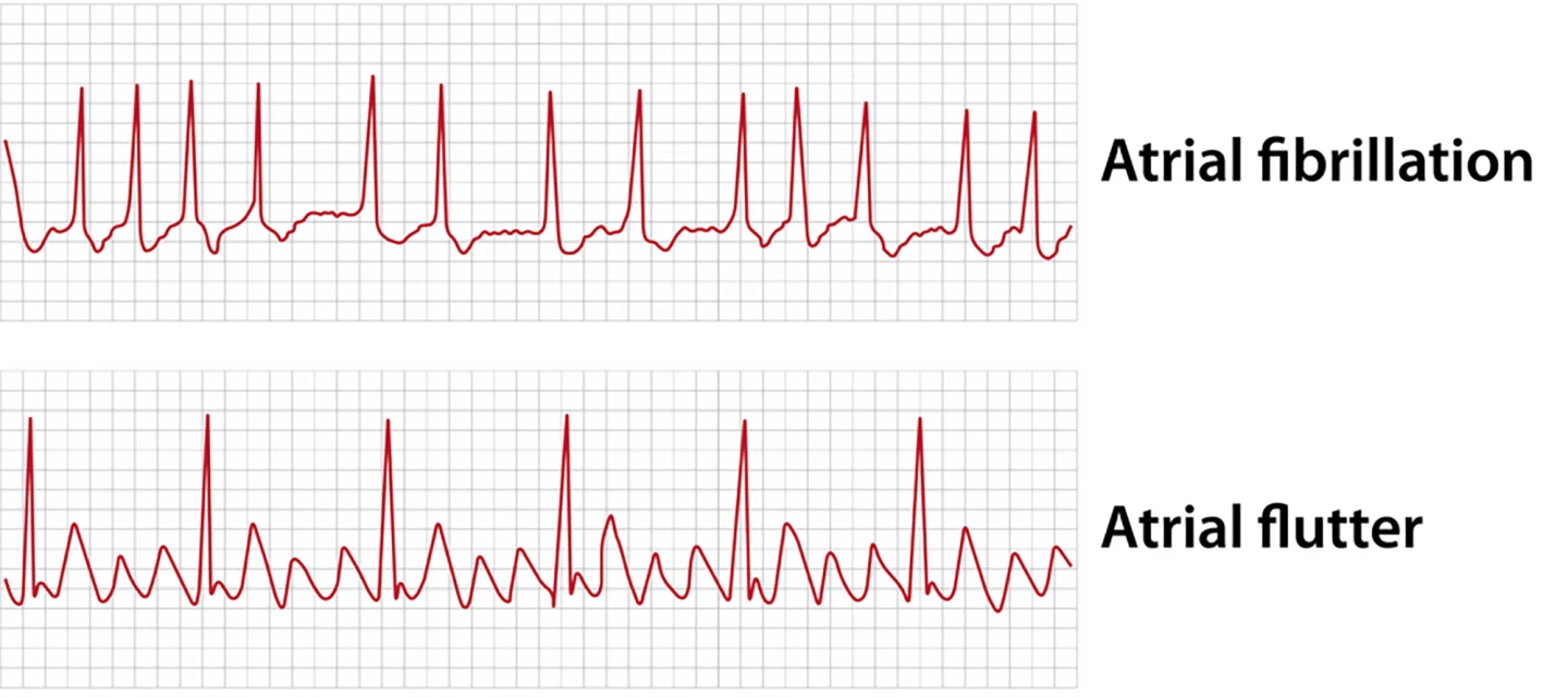 An ECG showing atrial fibrillation (AF) and the closely related rhythm disturbance, atrial flutter