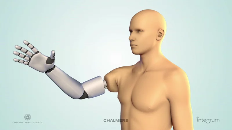 The Chalmers University prosthesis has been permanently connected to a patient for the first time