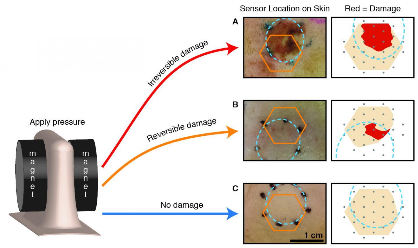 The orange hexagon marks where the bandage was placed on the skin of rats, and the dotted blue circle highlights where pressure was applied to the tissue – the “reversible damage” example highlights the sensitivity of the “smart bandage” impedance sensor since the wound is not visible at the surface of the skin (Image: UC Berkeley)