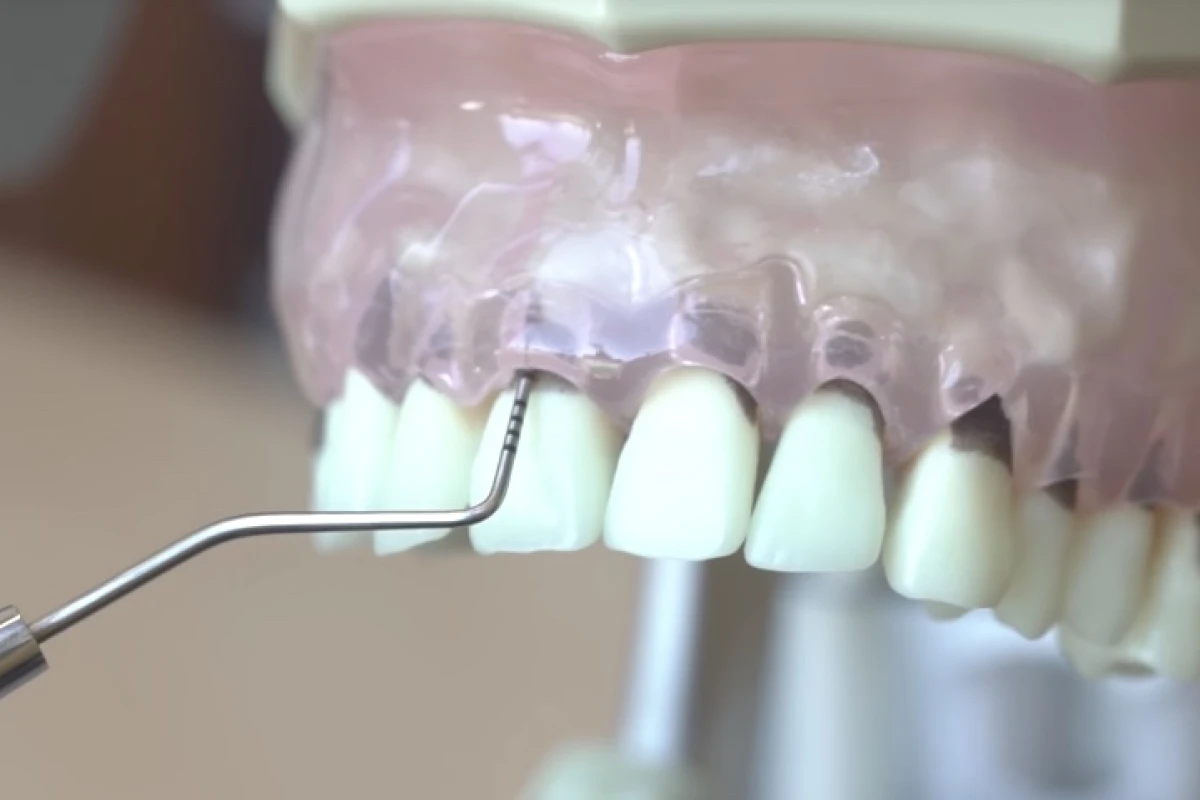 A standard periodontal probe is used on a dental model