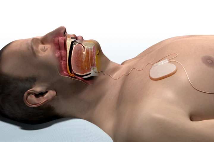 A rendering of a patient with the Inspire system installed