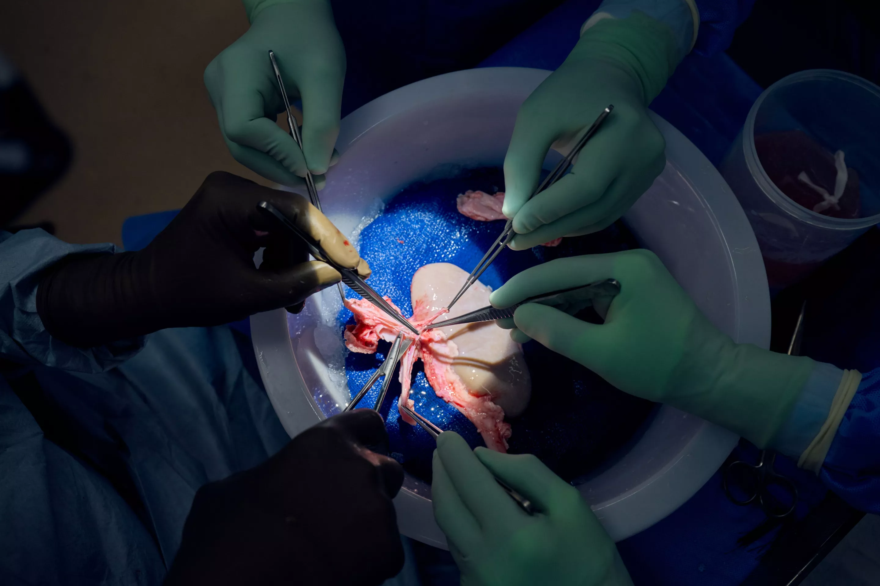The pig kidney being prepared for transplant