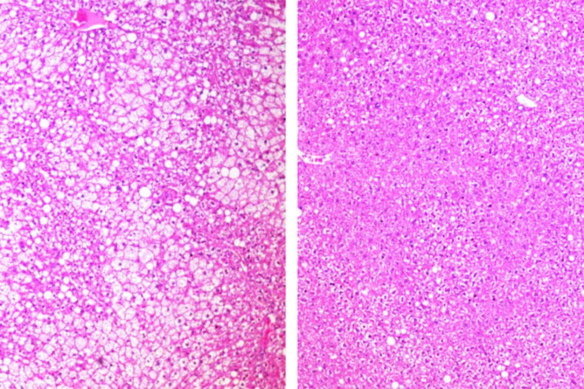 Fat deposits seen in white in liver tissue of untreated mice on the left, compared to mice treated with ADI-PEG 20 on the right