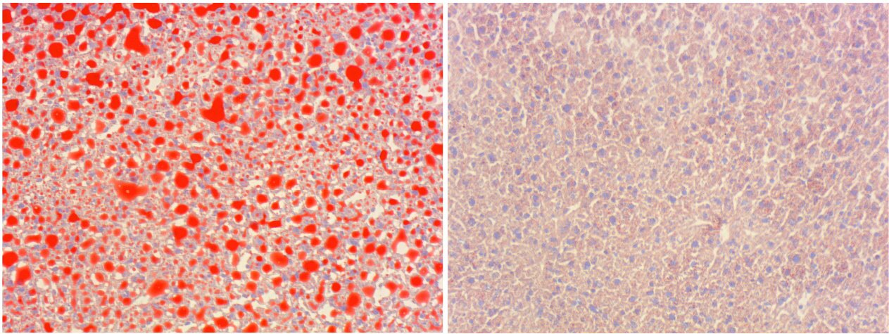 (Left) Liver cells with high levels of fat deposits, compared to those (right) that have had ceramide synthase 6 blocked, which reduces the fat build-up in the liver, despite eating the same diet