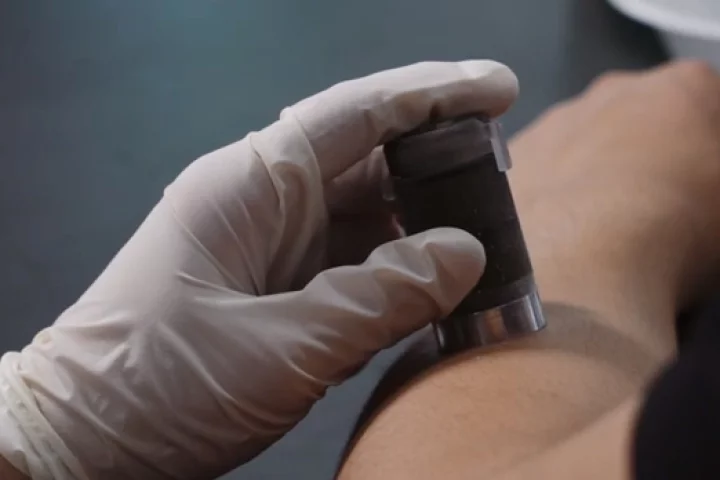 Team Comfortably Numb's skin-numbing device in use (Photo: Rice University)