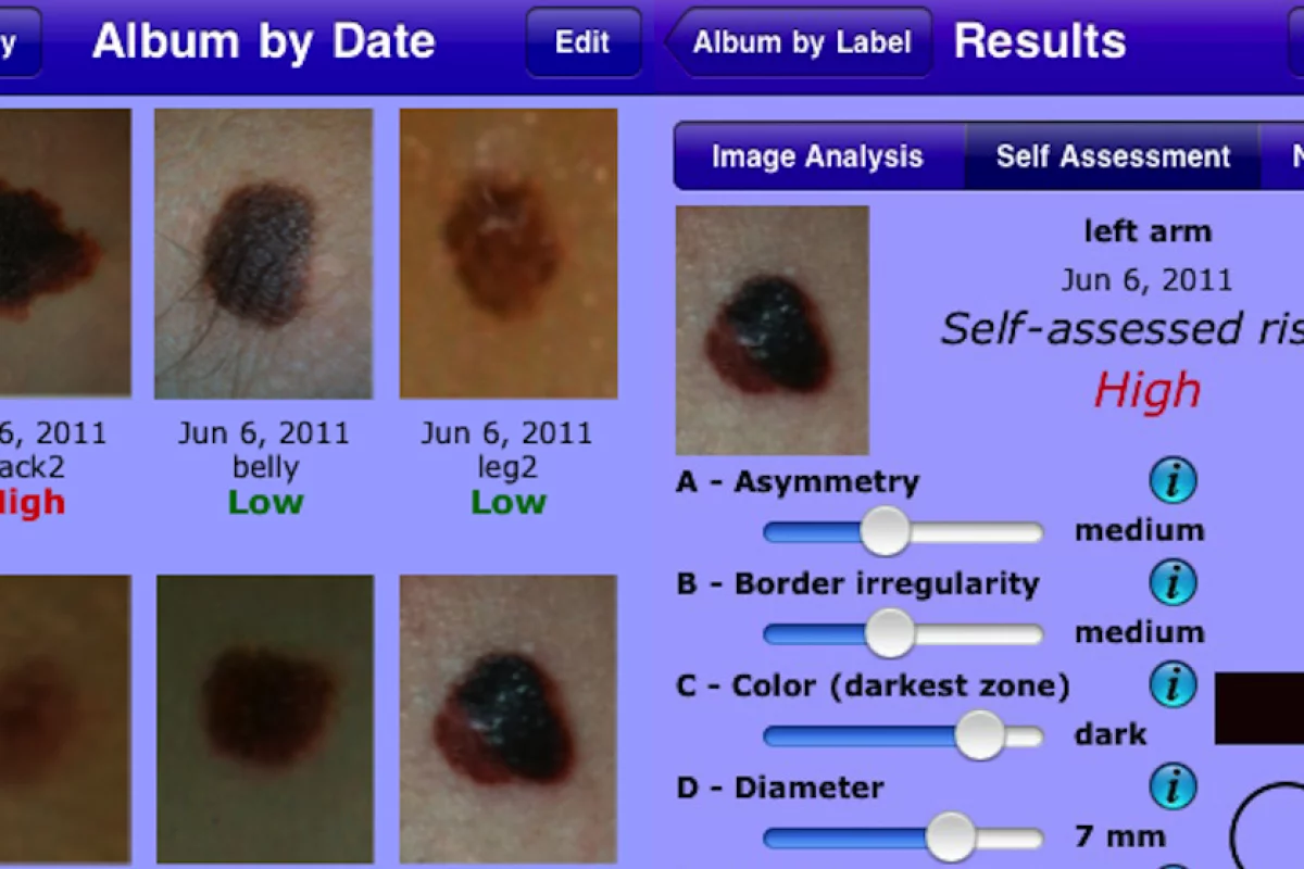 MelApp is an image-based risk assessment mobile app that assists in the early detection of melanoma