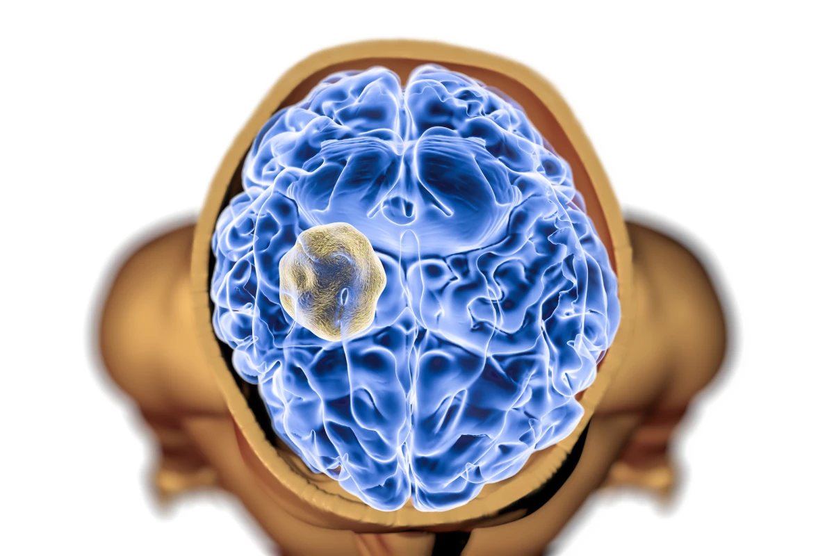A newly developed blood test could lead to more accurate ways of diagnosing brain cancer