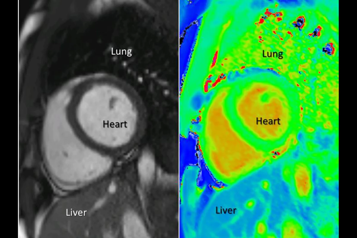 The T1 mapping technique (right) provides easier-to-interpret imagery than the existing MRI method (left)