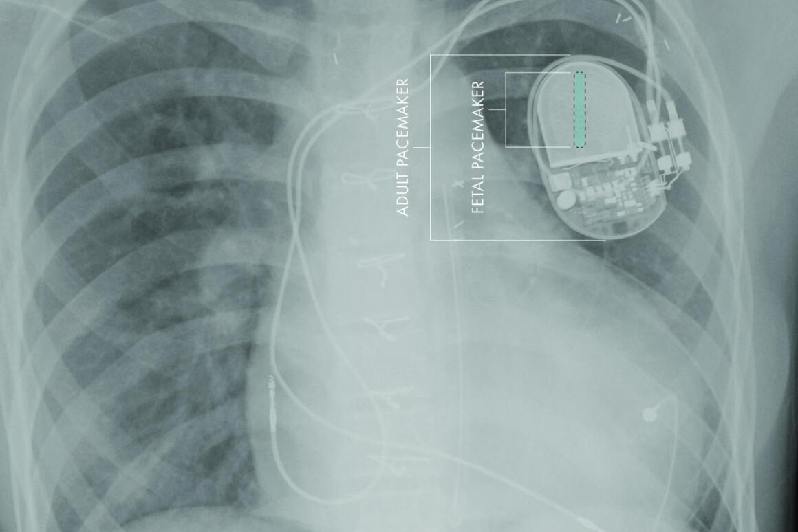 Miniature Pacemaker Designed To Be Implanted In Fetuses - 