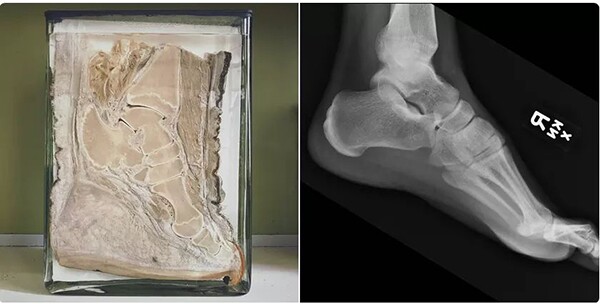 A cross section of an elephant's foot (left), and an x-ray of a human foot (right). Below the bones in the elephant's foot – which has a remarkably similar skeletal structure to the human – is a fleshy pad like that sauropods might have had