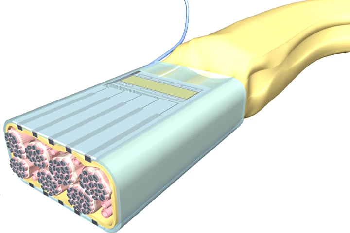 Artist’s concept of a flat interface nerve electrode (FINE)