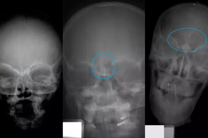 Skull X-rays of children in Stages 1, 2 and 3 of frontal sinus development