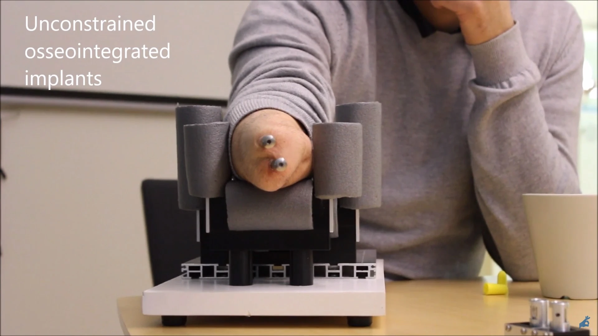 Image of the implants attached to the forearm bones that interface with the wrist prosthesis