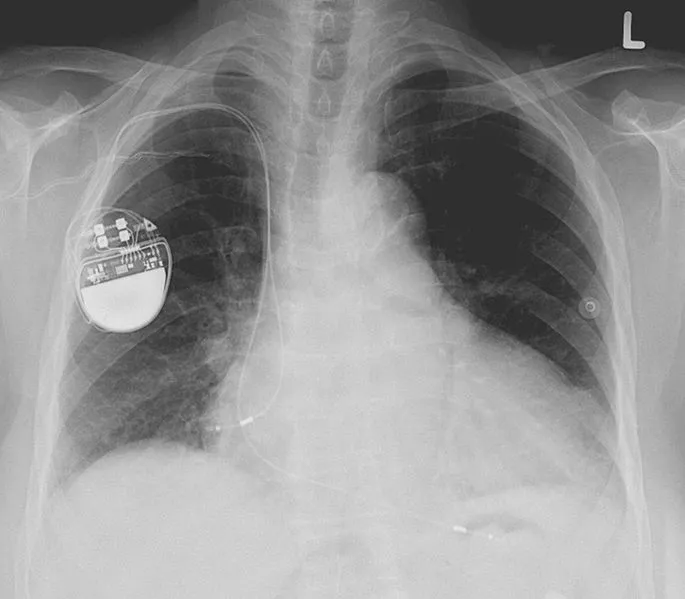 Scientists from MIT are designing a wearable signal jamming system, to protect implantable medical devices (such as this pacemaker) from wireless attacks (Image: Lucien Monfils)