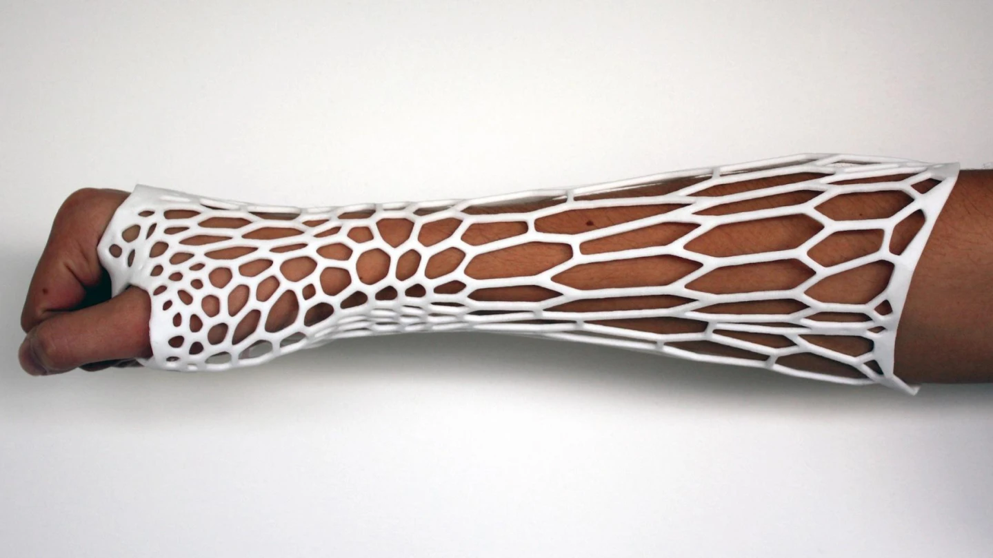 The cortex is a 3D-printed plastic cast designed to replace the traditional bulky plaster casts