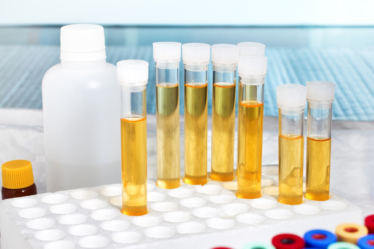 A new predictive test for bladder cancer shows promise but still needs further verification in larger cohorts of patients