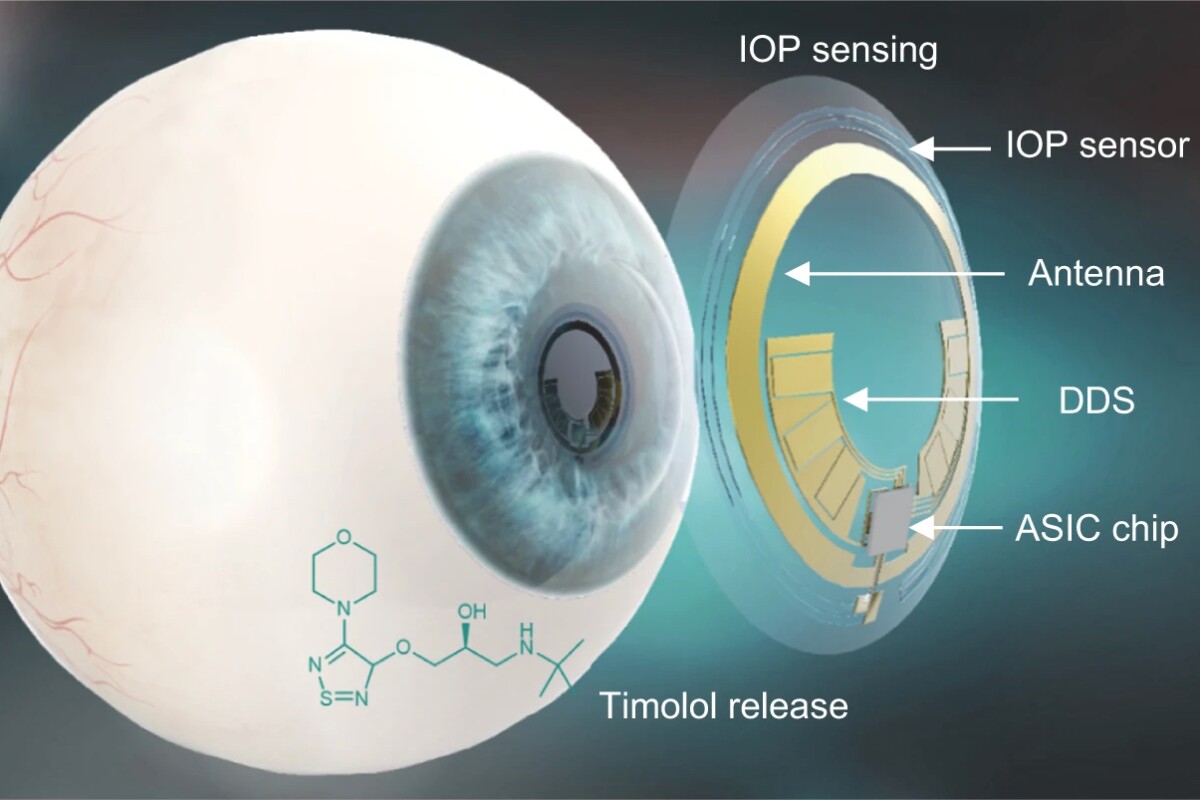 A diagram of the pressure-sensitive timolol-dispensing contact lens