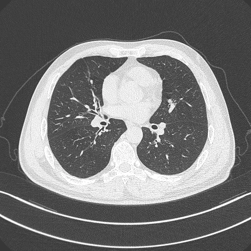 CT scan