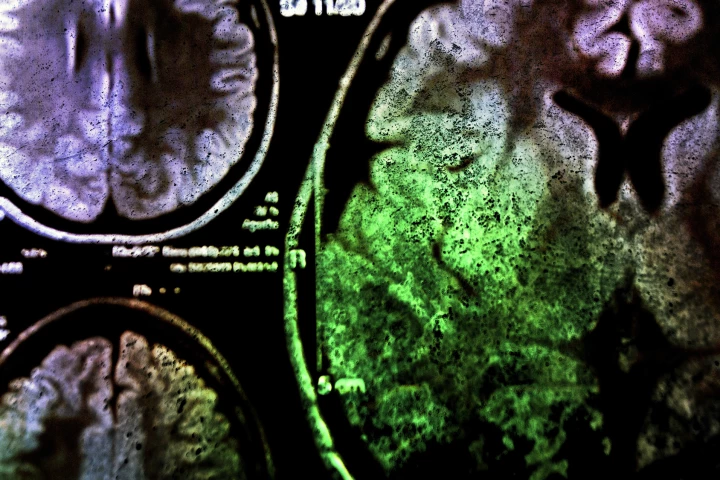 Scientists have figured out a way to prevent brain injury caused by radiotherapy for cancer