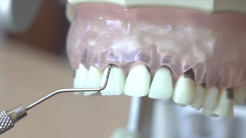 A standard periodontal probe is used on a dental model