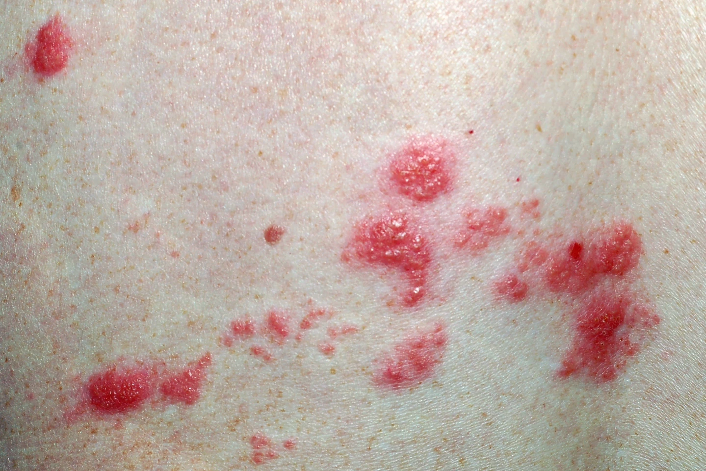 Shingles (herpes zoster) is characterized by a painful blistering rash