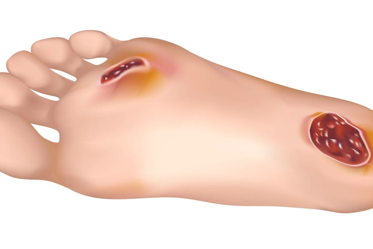Plans call for the lamp to be tested on diabetic ulcers within 12 months