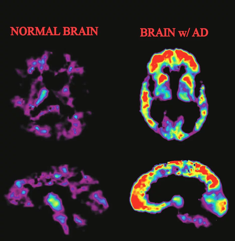 PET scans of beta amyloid in a normal brain at left, and in the brain of a patient with Alzheimer's at right (Photo: National Institute on Aging)